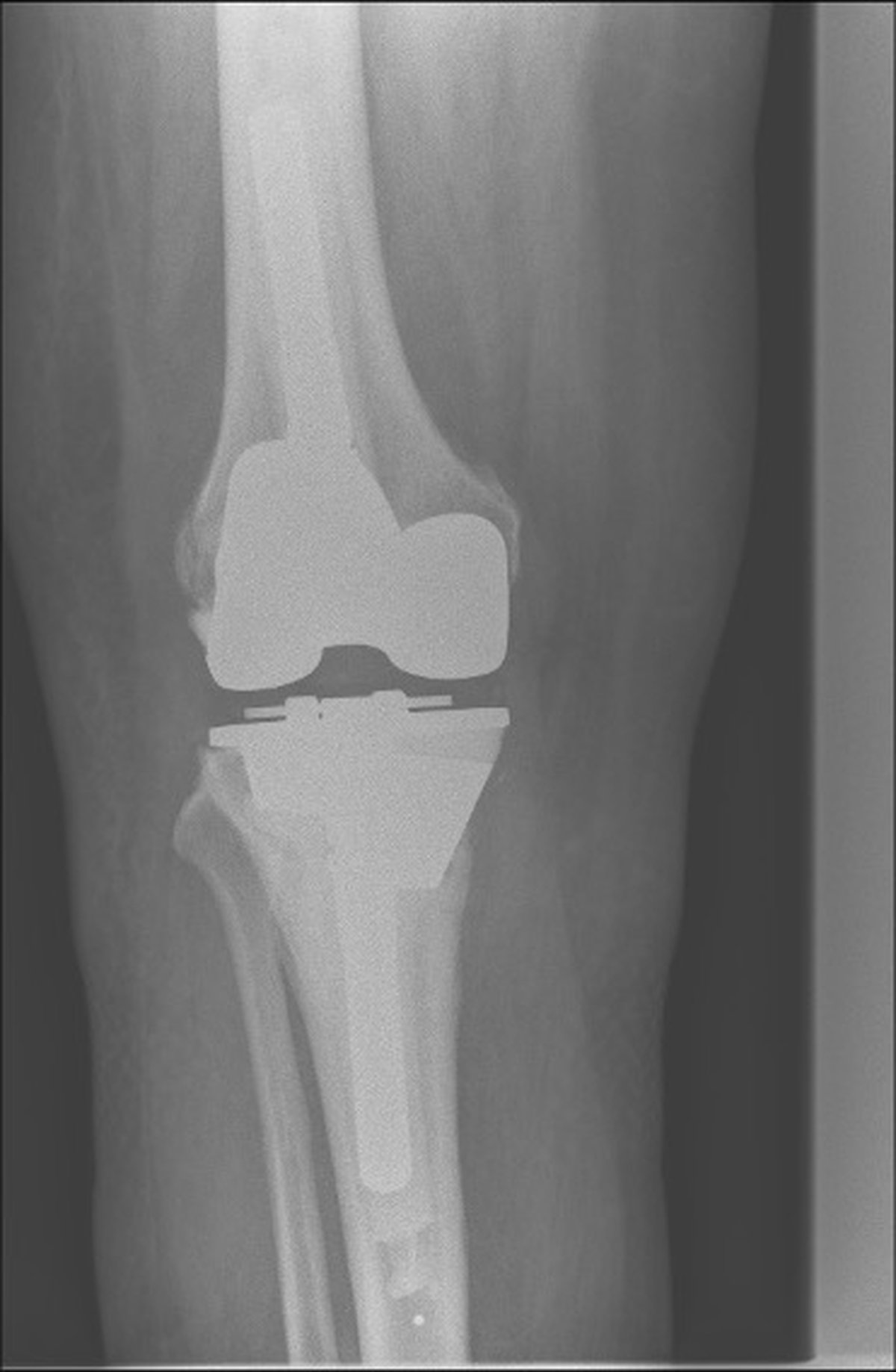 Post-operative knee x-ray after complex revision with a large trabecular metal augment in the tibia and correction of deformity
