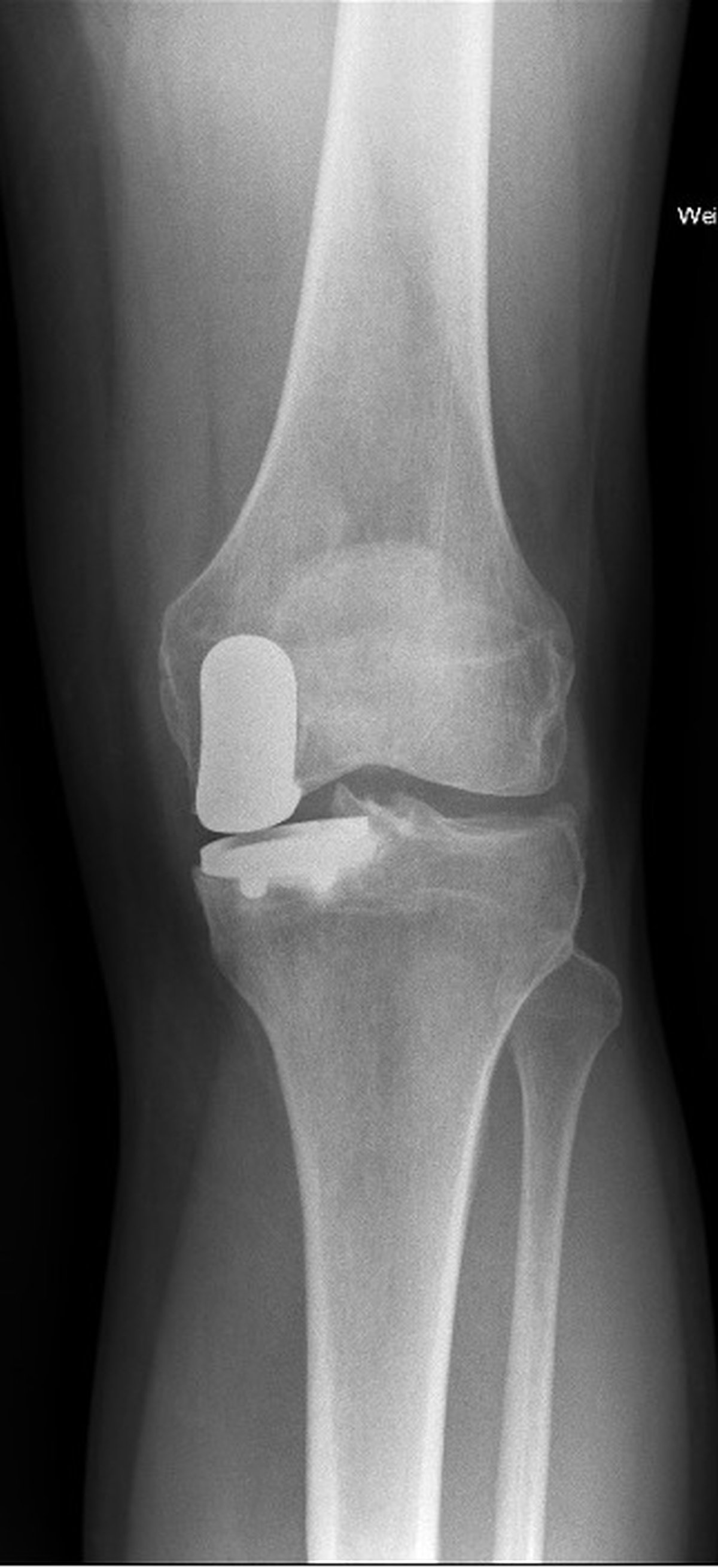 Post-operative knee x-ray after partial knee replacement performed using the MAKO robotic platform with the unaffected compartments preserved