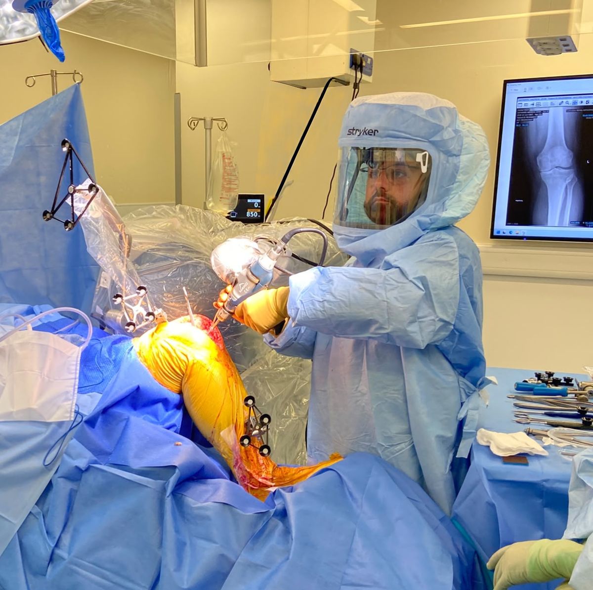 Mr Shakir Hussain performing MAKO robotic knee replacement surgery in Birmingham using the haptic-controlled handpiece