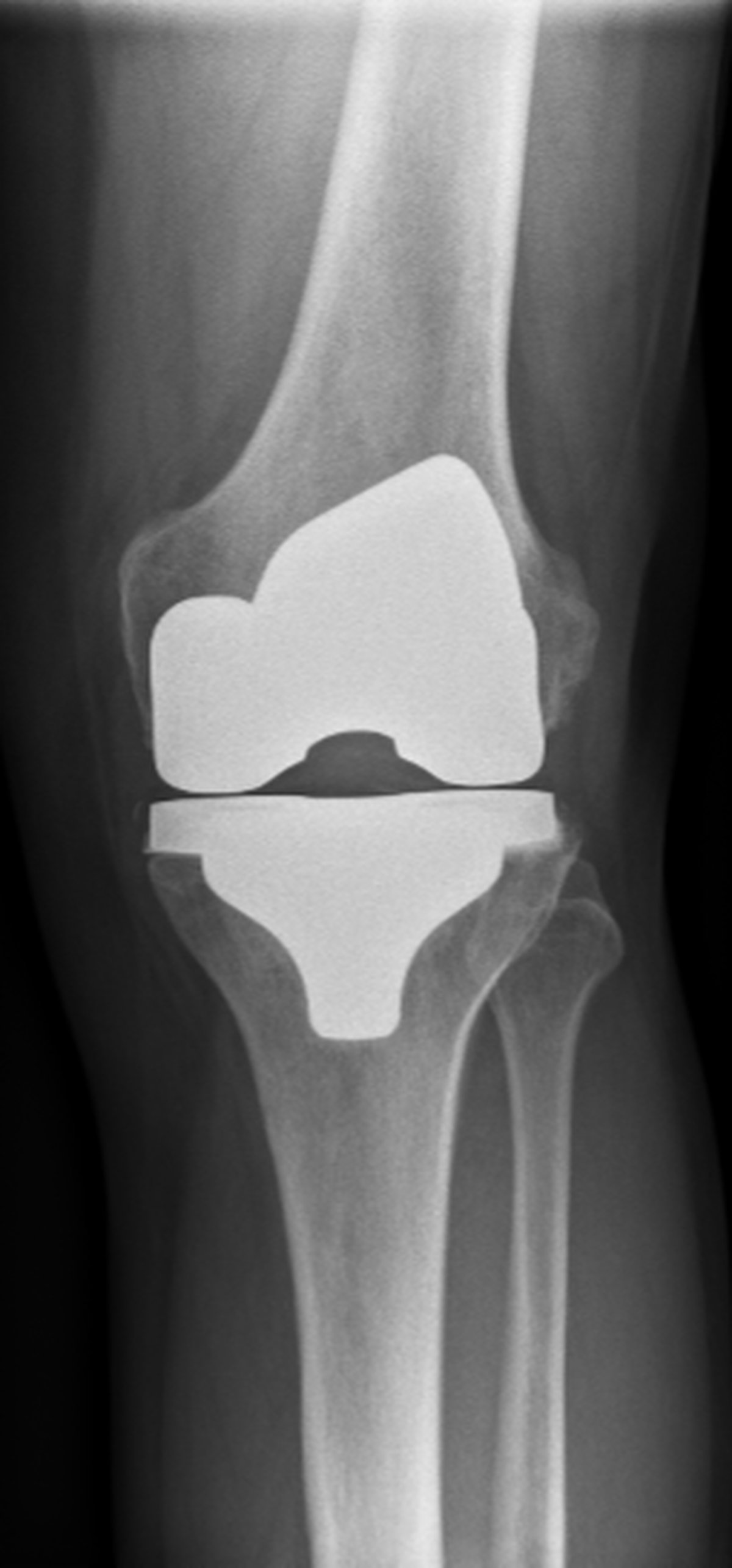 Post-operative knee x-ray after total knee replacement performed using the MAKO robotic platform with well-positioned implant