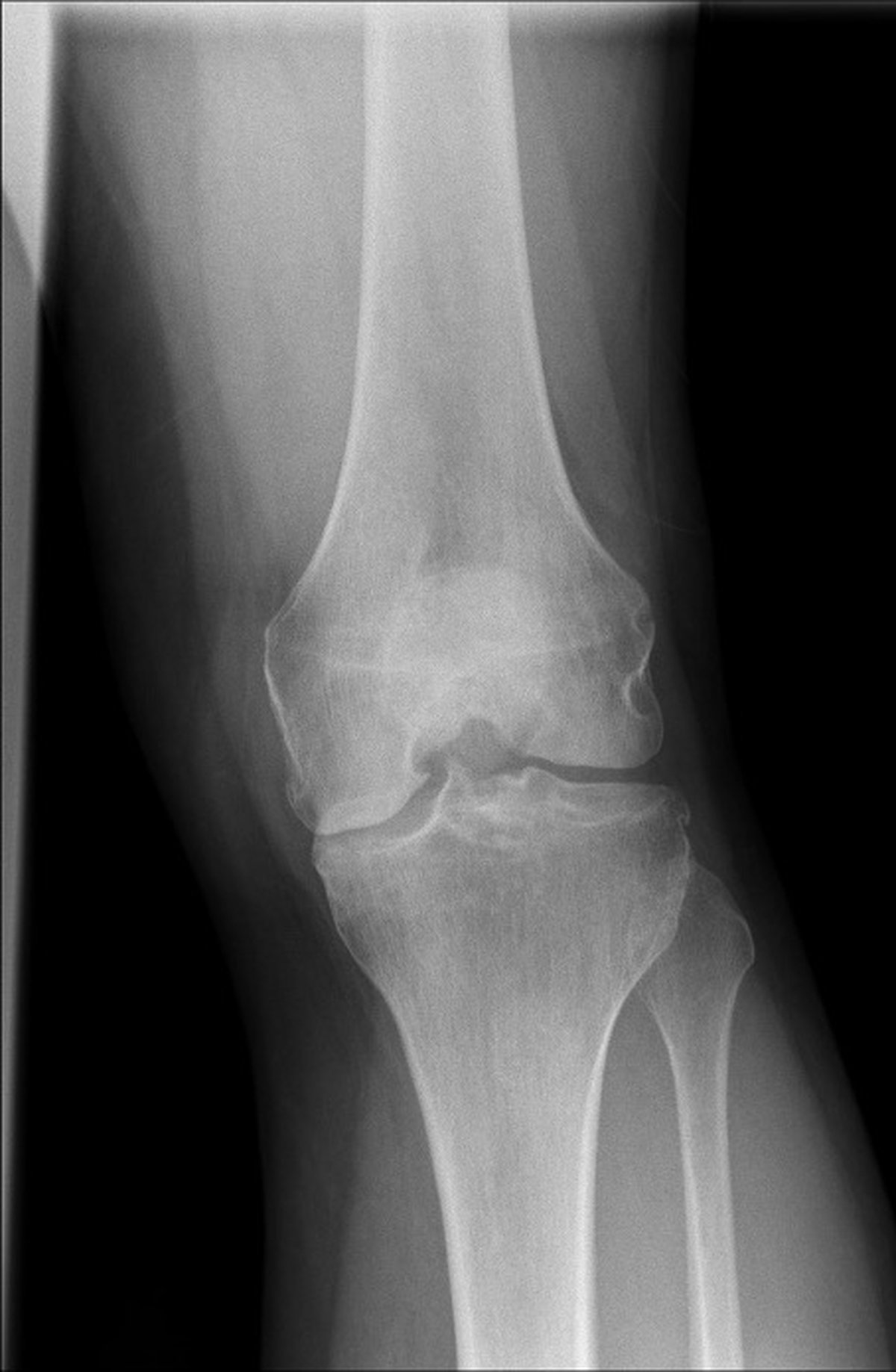 Pre-operative knee x-ray showing medial compartment osteoarthritis with joint space narrowing