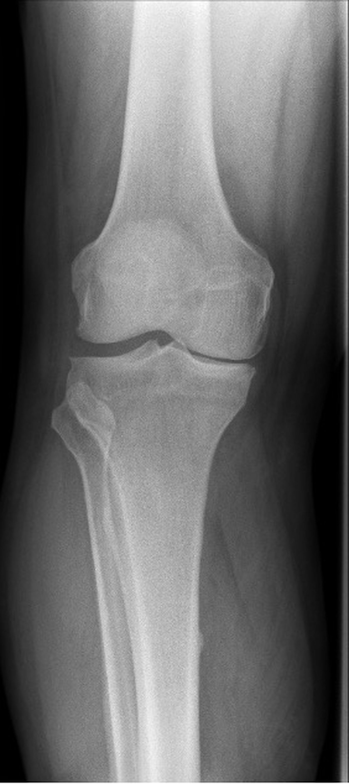 Pre-operative knee x-ray showing isolated medial compartment osteoarthritis with joint space narrowing