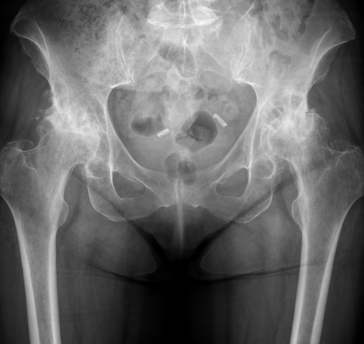 Pre-operative pelvis x-ray showing end-stage osteoarthritis of both hips with complete loss of joint space before simultaneous bilateral hip replacement