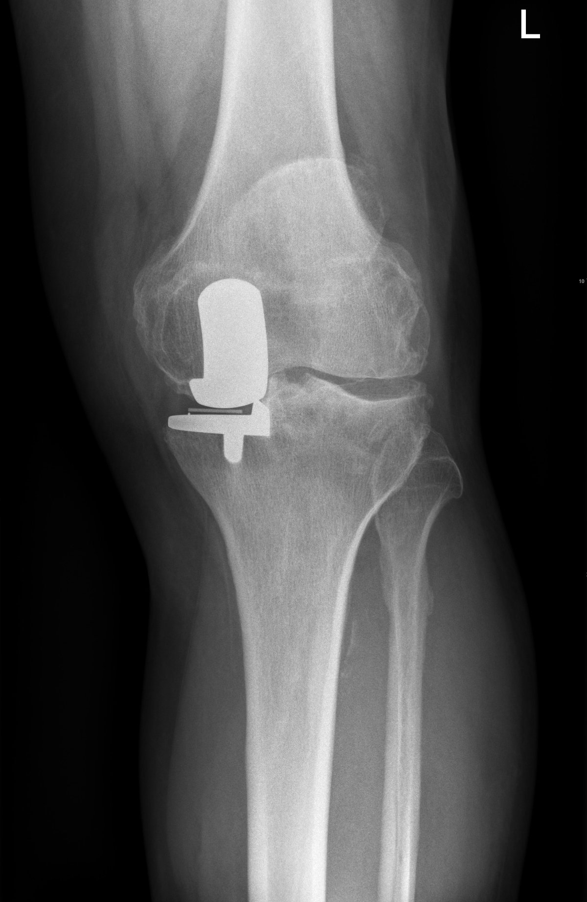 Pre-operative x-ray of a failed partial knee replacement with arthritis progressing across the rest of the knee, before robotic revision knee replacement in Birmingham
