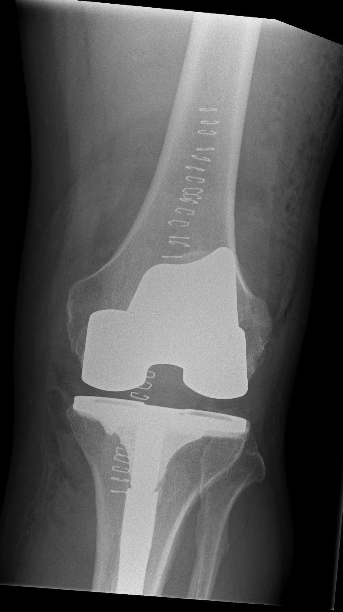 Robotic revision knee replacement in Birmingham: post-operative x-ray after CORI robotic-assisted revision of a failed partial knee to a stemmed total knee replacement