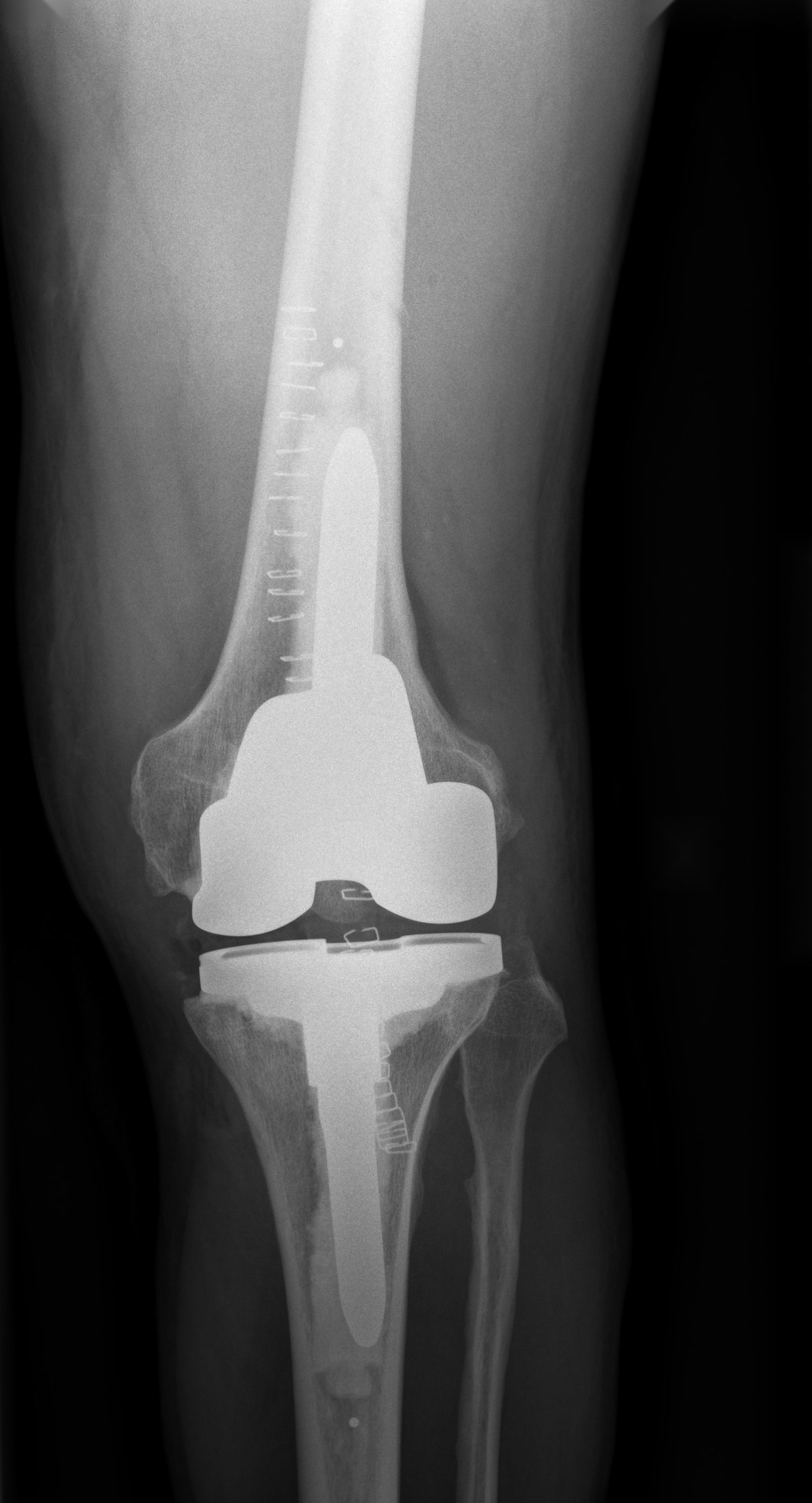 Post-operative x-ray after CORI robotic-assisted revision of a stiff total knee replacement to stemmed revision components, Birmingham