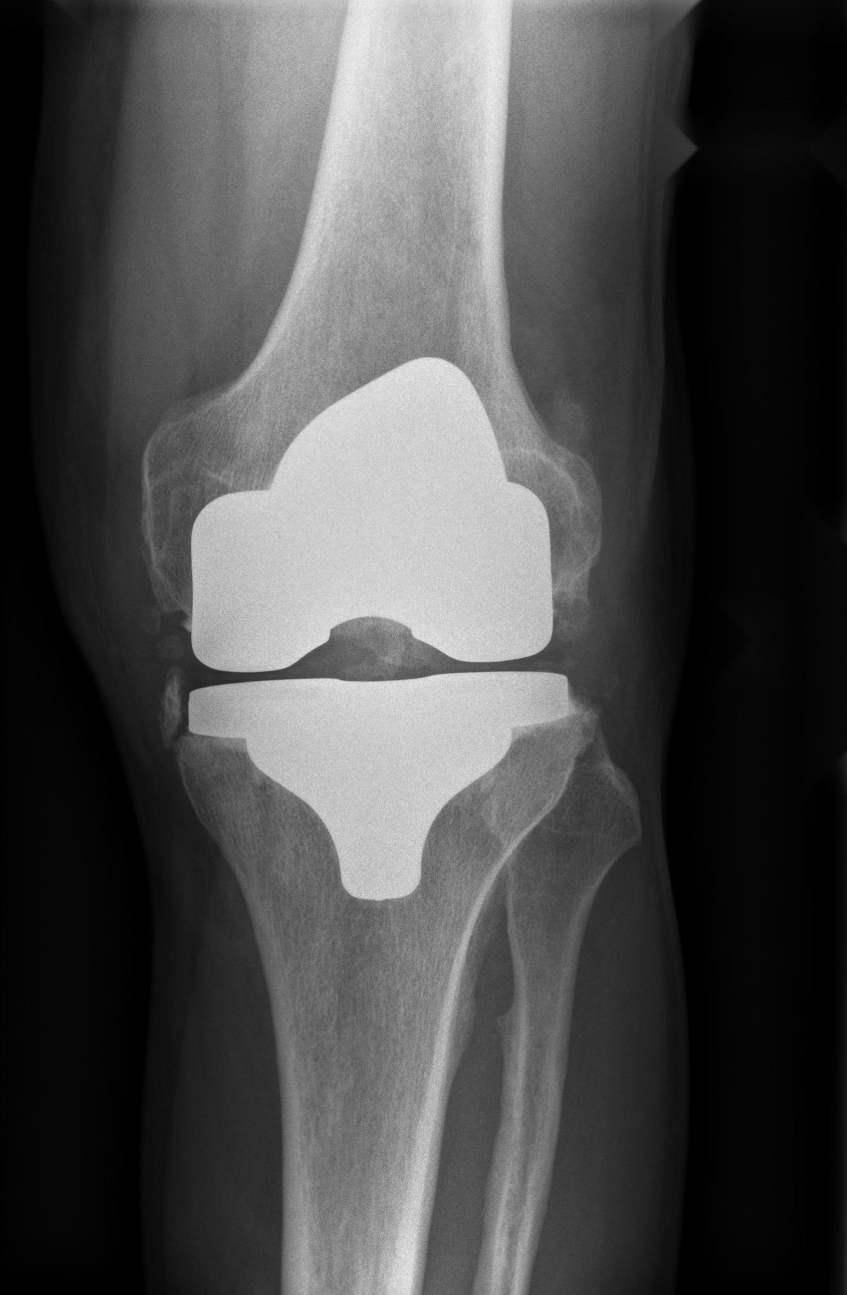 Pre-operative x-ray of a stiff, painful total knee replacement with well-fixed components before CORI robotic revision knee replacement in Birmingham