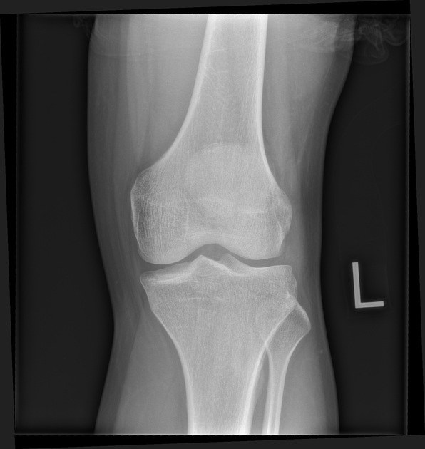 Normal knee X-ray showing a healthy joint space between the femur and tibia where the cartilage is preserved