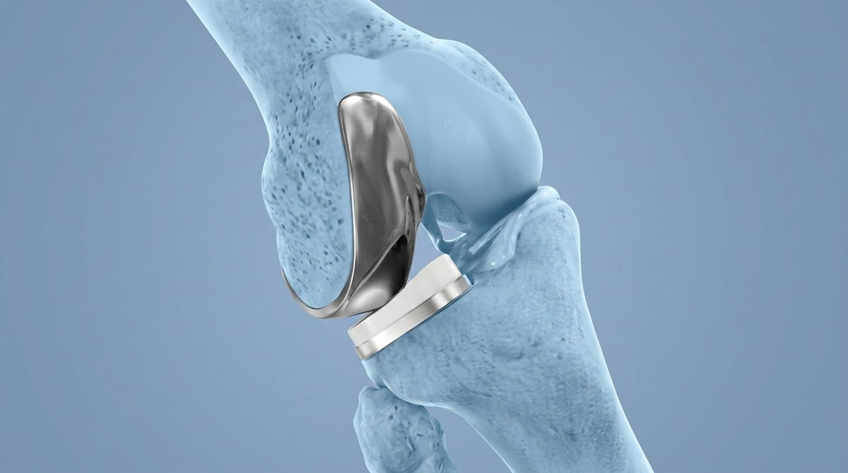 Illustration of partial (unicompartmental) knee replacement showing the implant resurfacing the worn medial compartment of the knee
