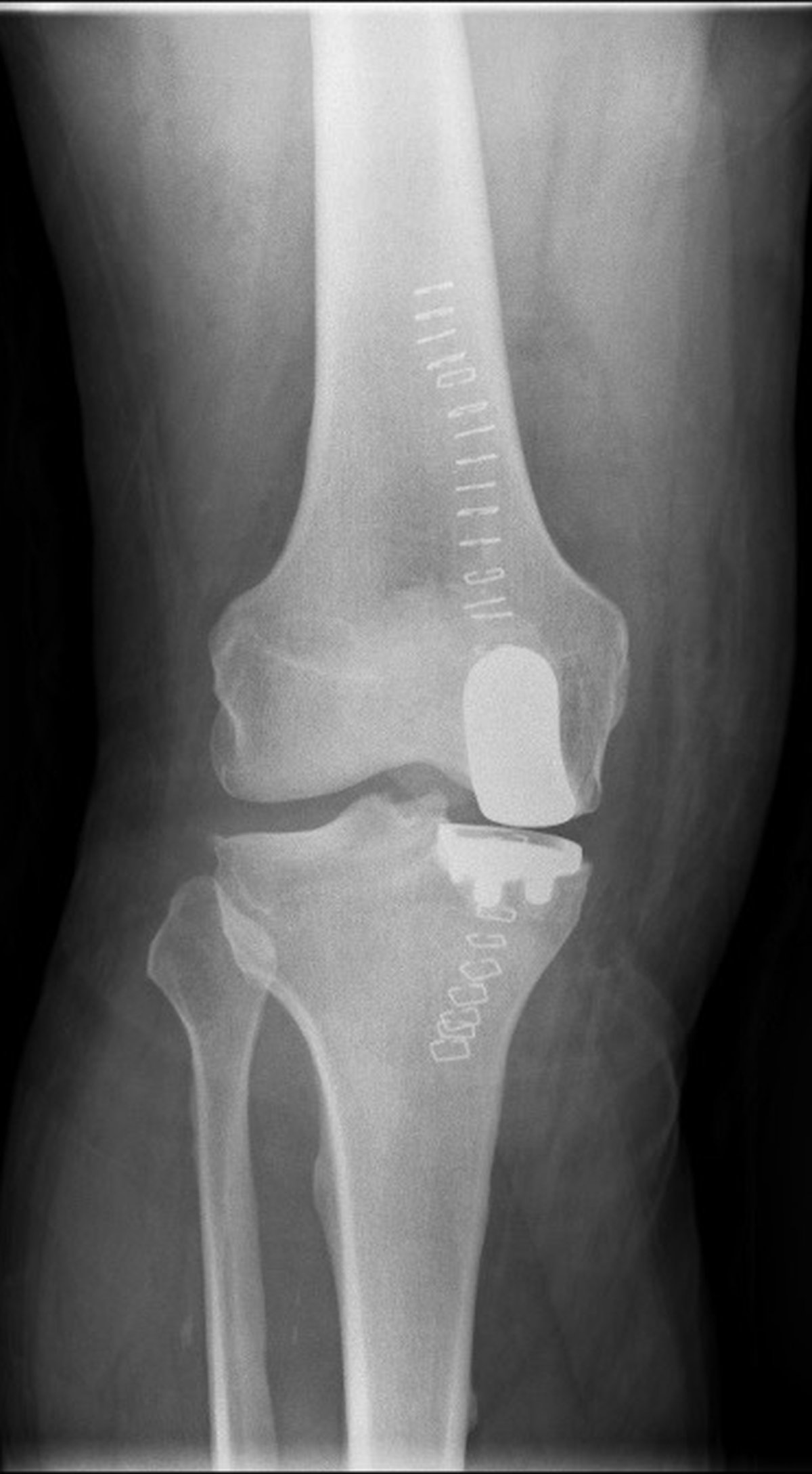 Post-operative knee x-ray after partial medial knee replacement with the lateral compartment preserved