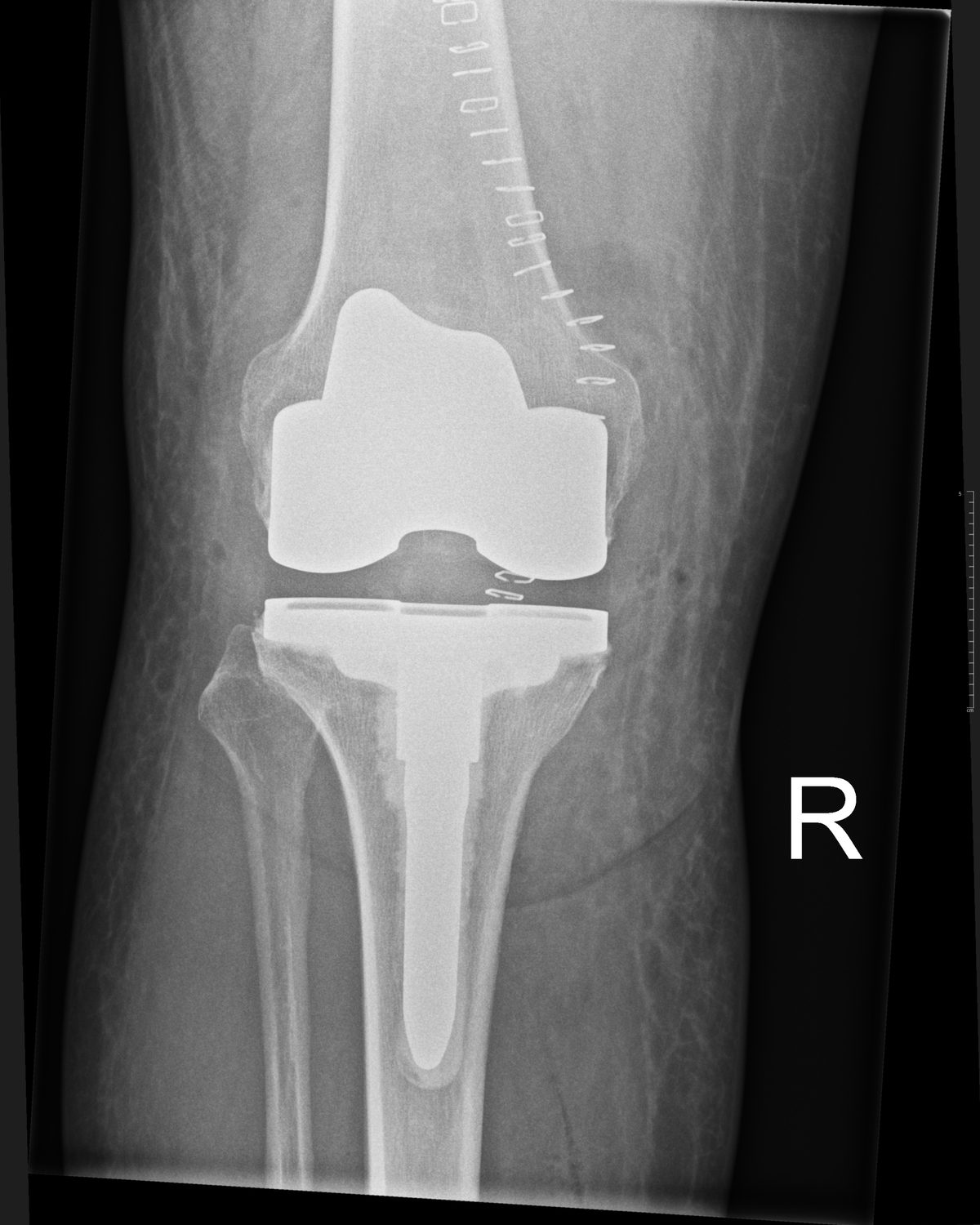 Post-operative x-ray after robotic-assisted revision of a partial knee replacement to a total knee replacement with a stemmed tibial component