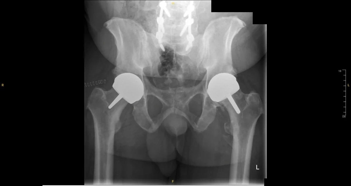 Post-operative AP pelvis X-ray showing bilateral hip resurfacing implants well-positioned on both sides, with lumbar spinal fusion metalwork visible centrally