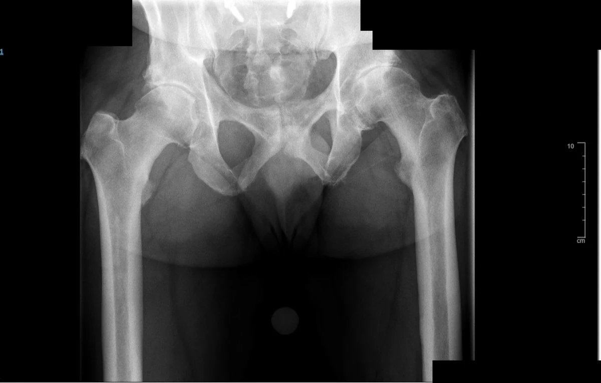 Pre-operative AP pelvis X-ray showing bilateral end-stage hip osteoarthritis with complete loss of joint space and osteophyte formation, and lumbar spinal fusion metalwork visible centrally
