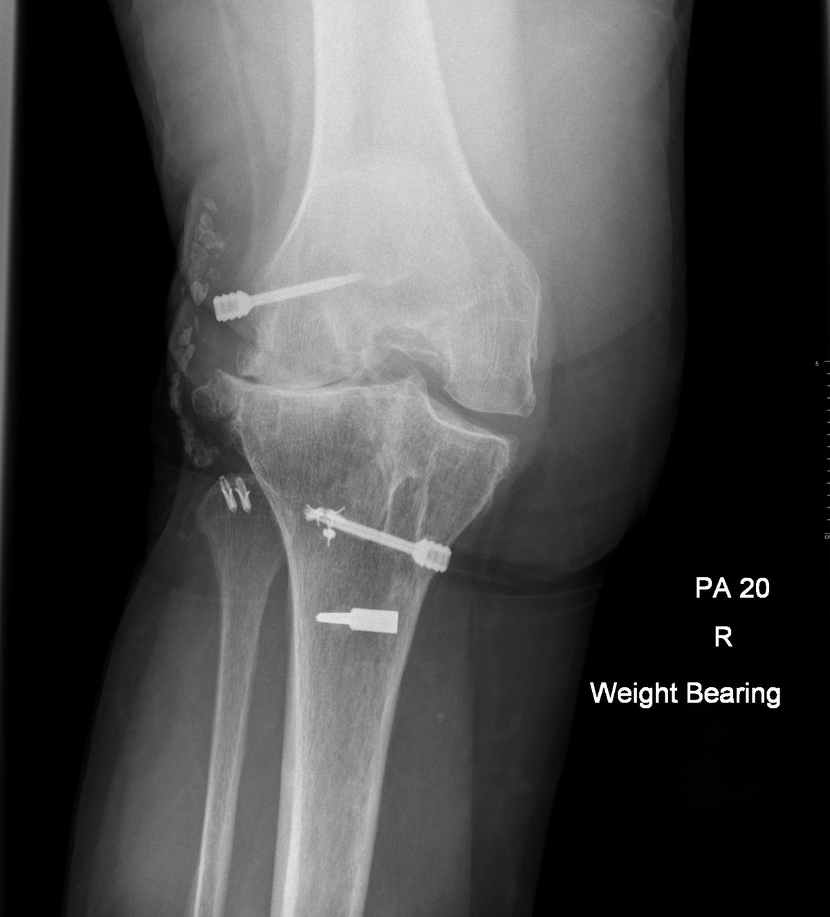 Pre-operative weight-bearing x-ray showing severe post-traumatic knee arthritis with retained metalwork 20 years after ligament reconstruction