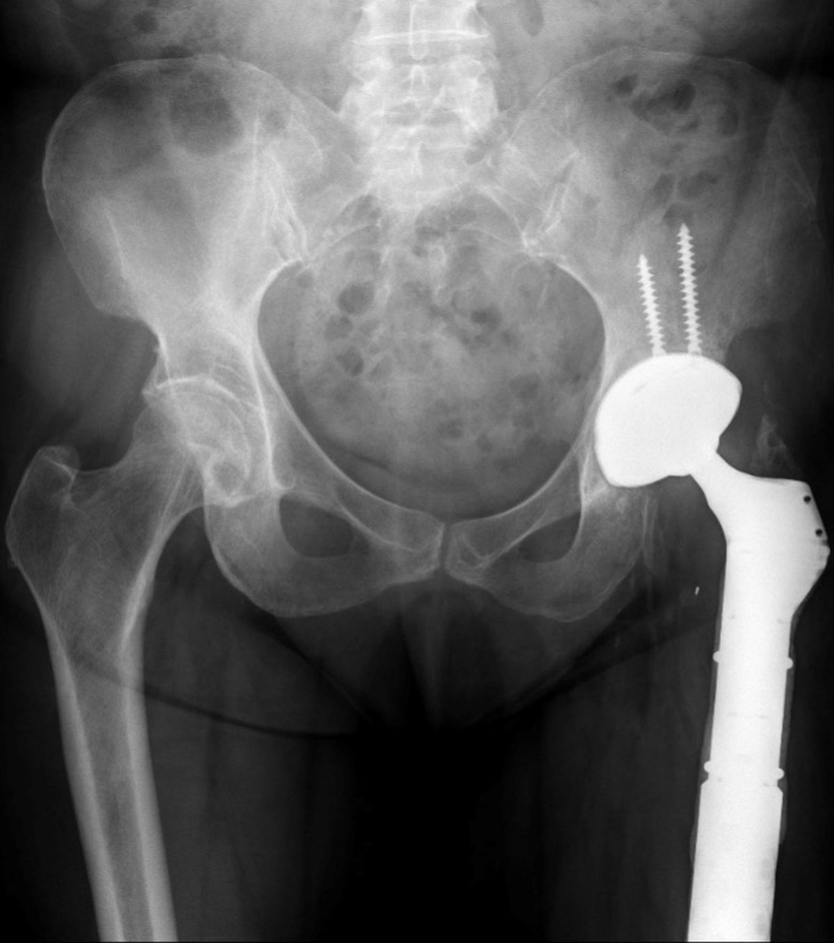 Post-operative x-ray after infection treatment and reconstruction with a proximal femoral replacement