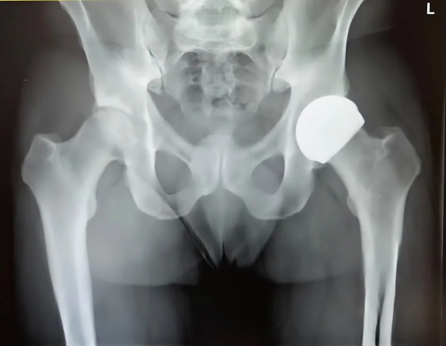 Post-operative X-ray of a ReCerf ceramic-on-ceramic hip resurfacing implant (MatOrtho), performed by Mr Shakir Hussain at the Royal Orthopaedic Hospital Birmingham
