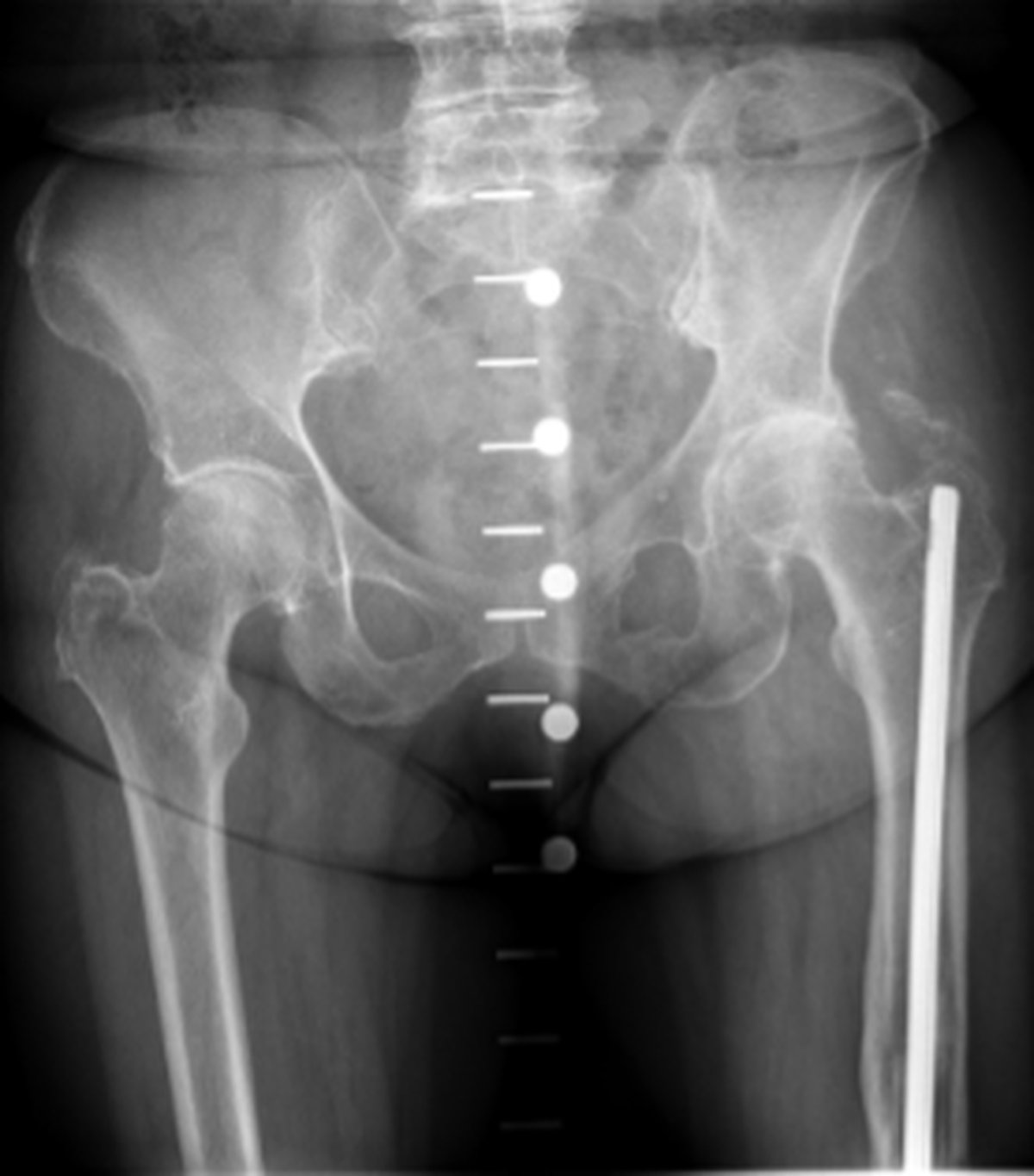 Pre-operative hip x-ray showing a long-standing femoral nail in place from a previous fracture fixation