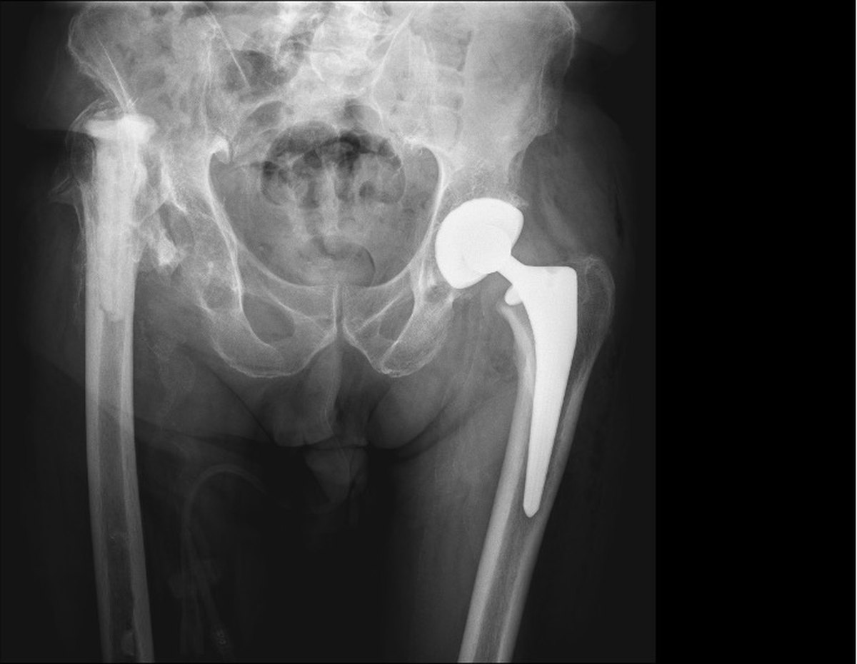 X-ray of a failed, infected right hip after removal of all implants, with severe bone loss and 8cm of leg shortening, before complex revision hip reconstruction in Birmingham