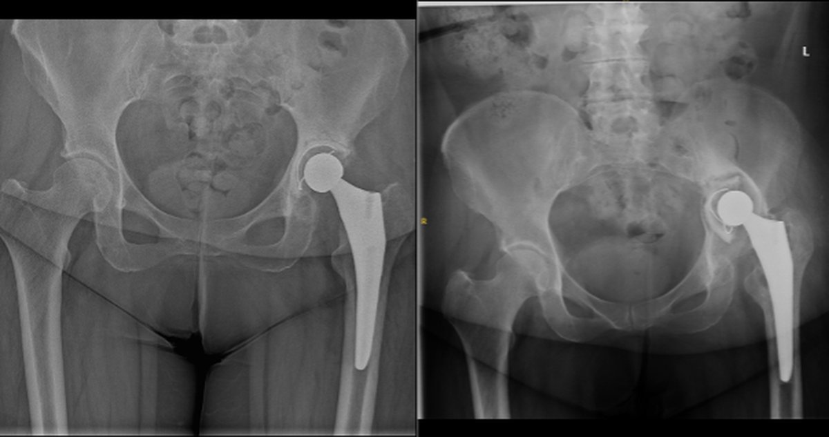 Pre-operative pelvic x-ray showing chronic prosthetic joint infection of a hip replacement