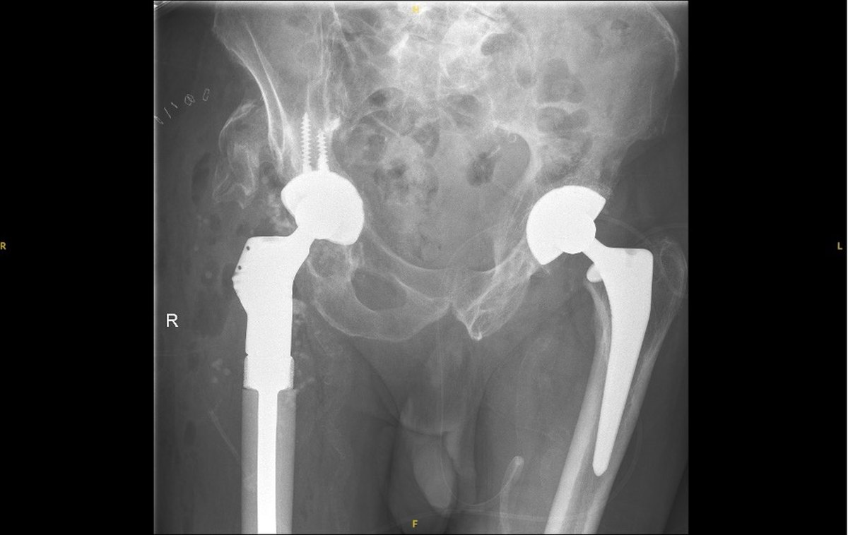 X-ray after complex revision hip reconstruction by Mr Shakir Hussain in Birmingham using a proximal femoral replacement, dual mobility socket and screw fixation, with leg length restored
