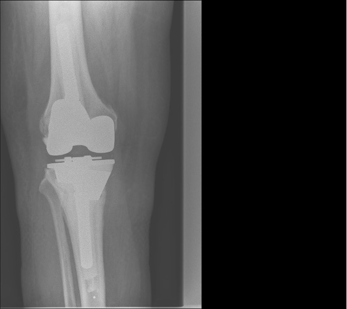 X-ray after revision total knee replacement by Mr Shakir Hussain in Birmingham, showing complex tibial bone-loss reconstruction with a large trabecular metal augment and corrected alignment