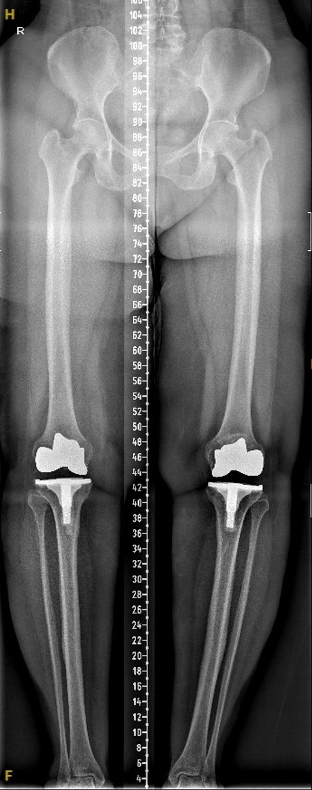 Post-operative long-leg standing x-ray after staged bilateral robotic knee replacement showing good correction of varus alignment