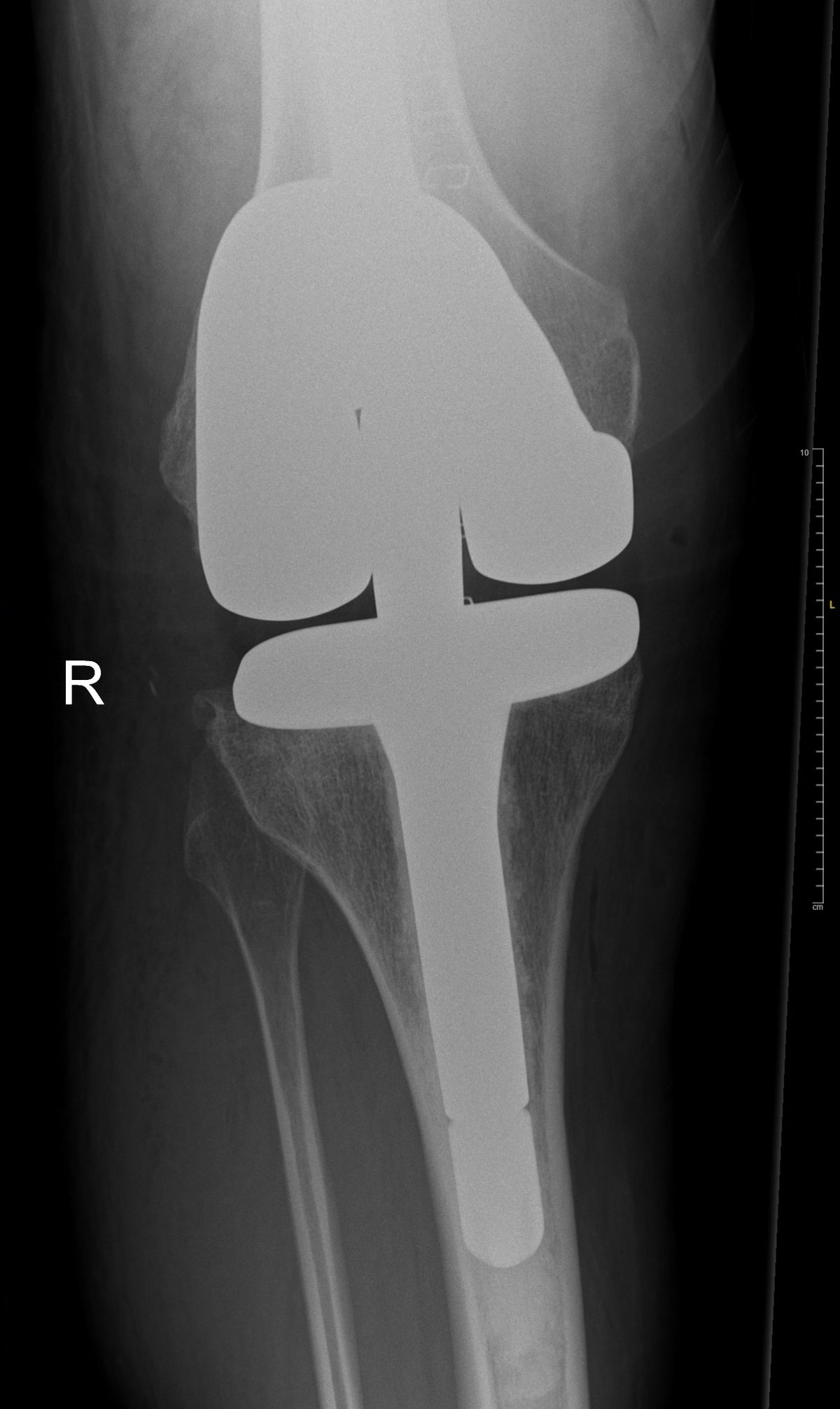Post-operative x-ray of a rotating hinge knee replacement with stemmed femoral and tibial components correcting severe valgus deformity