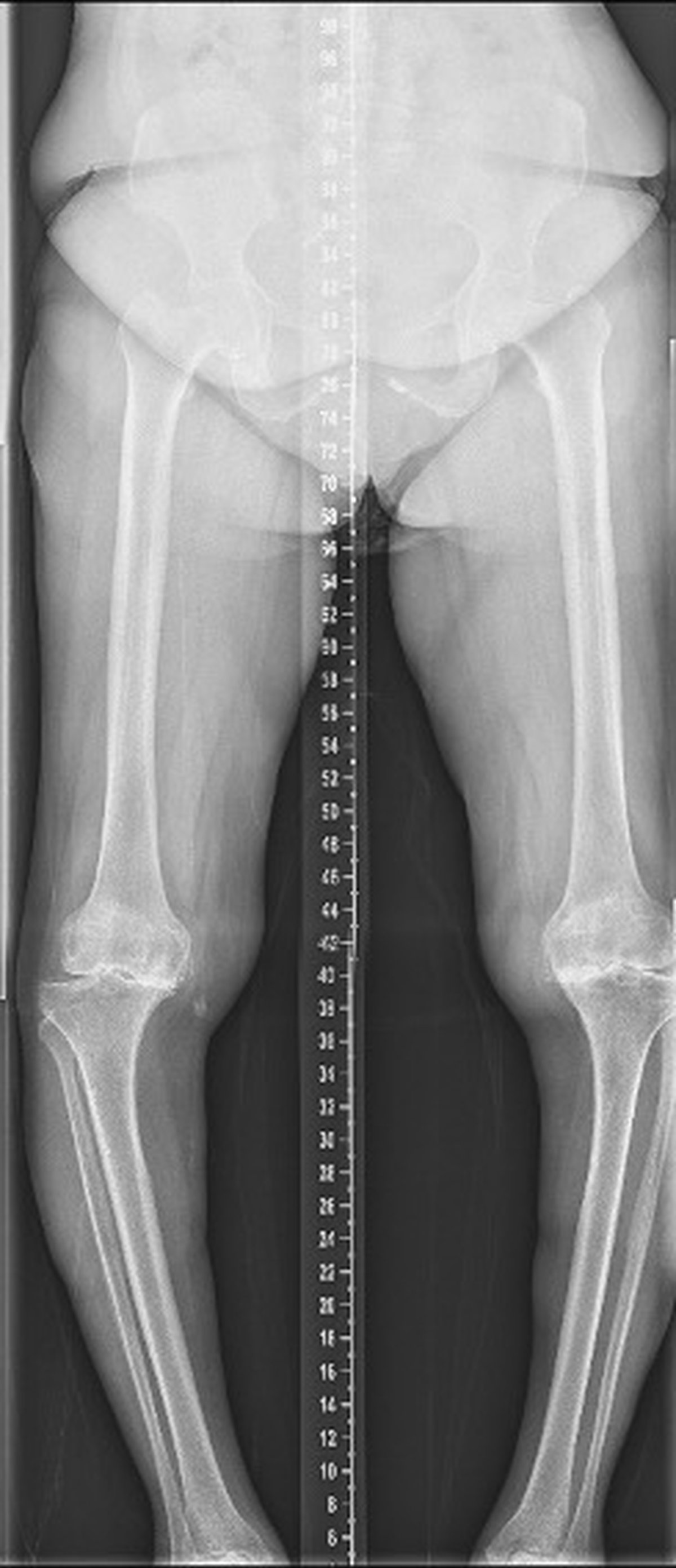 Pre-operative long-leg standing x-ray showing severe varus deformity of both knees