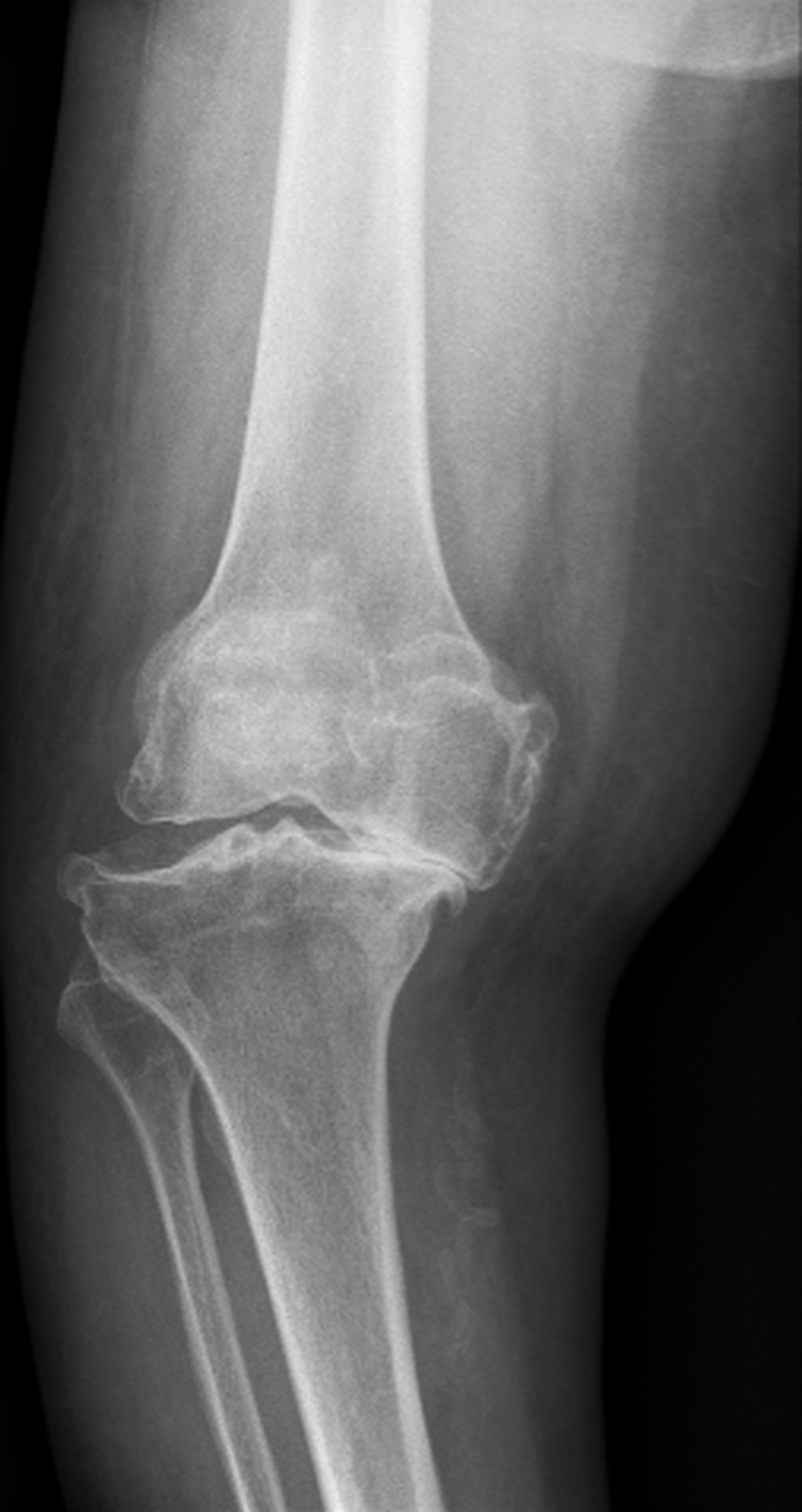Pre-operative knee x-ray showing severe deformity with associated osteoarthritis
