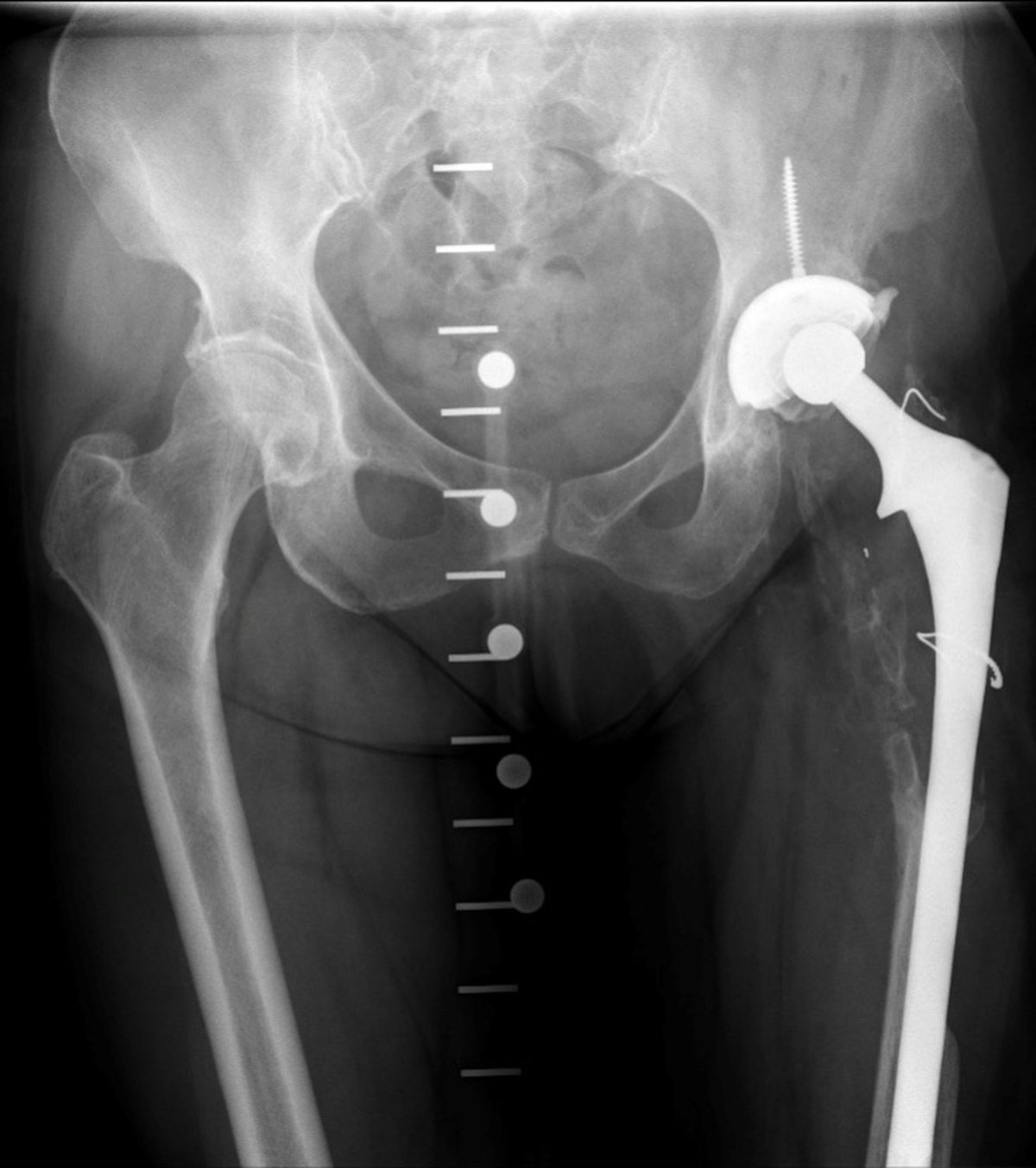 Pre-operative x-ray showing severe bone loss of the femur due to chronic infection of a previous hip implant