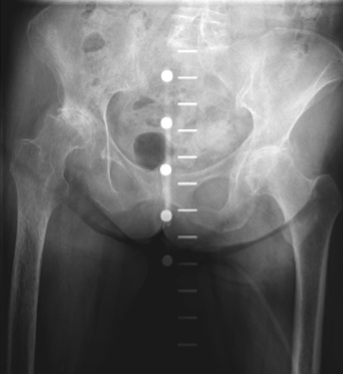 Pre-operative pelvic x-ray showing severe osteoarthritis of the hip with joint space narrowing and altered anatomy