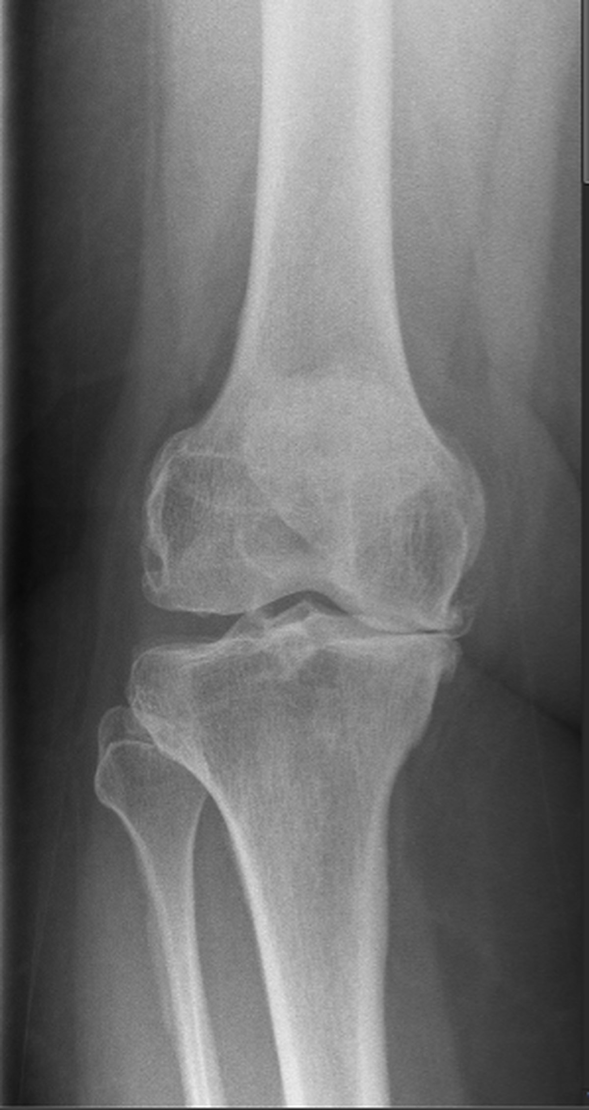 Pre-operative knee x-ray showing severe osteoarthritis with joint space narrowing and bone-on-bone changes