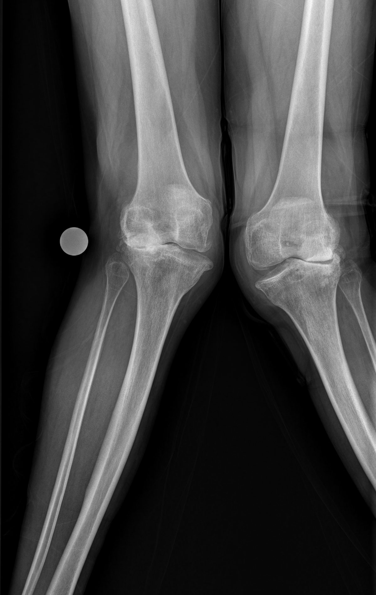 Pre-operative standing x-ray showing severe valgus knee deformity and fixed flexion contracture before complex knee replacement in Birmingham