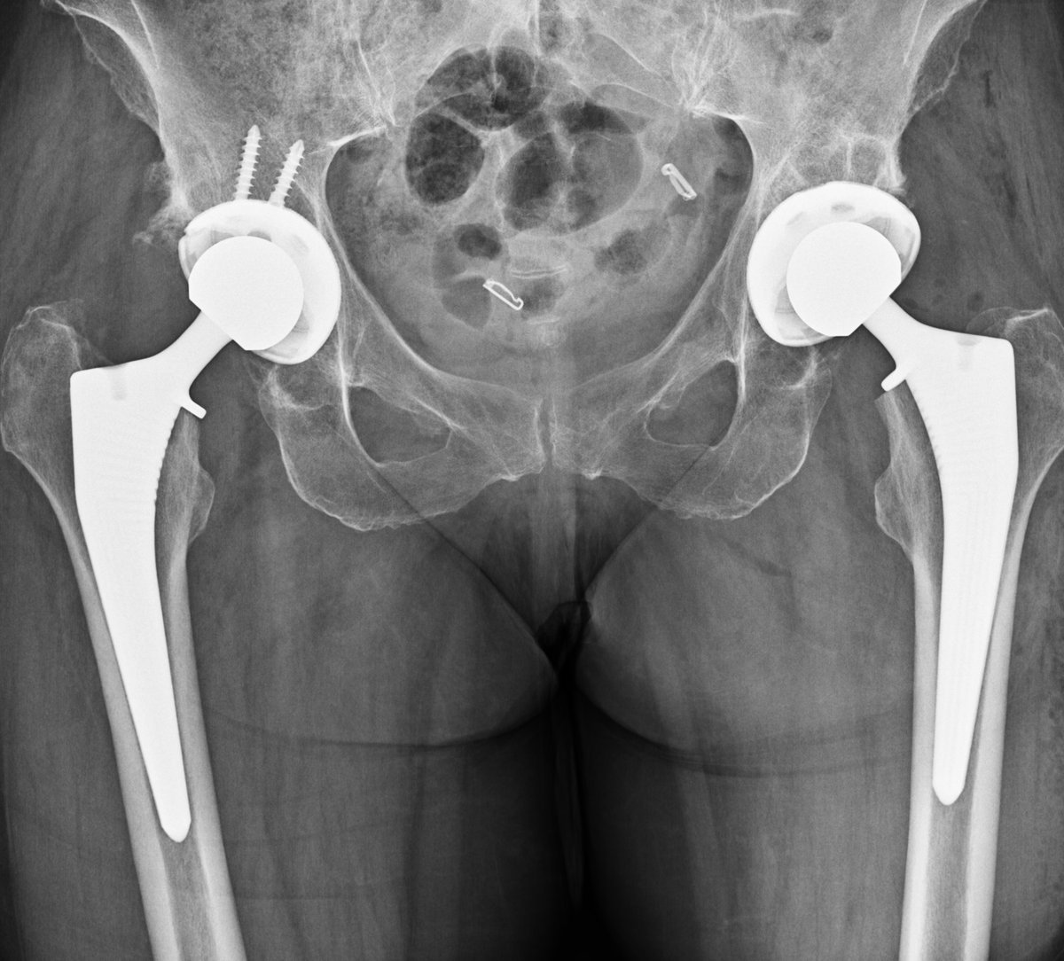 Post-operative pelvis x-ray after simultaneous bilateral total hip replacement showing well-positioned uncemented implants in both hips