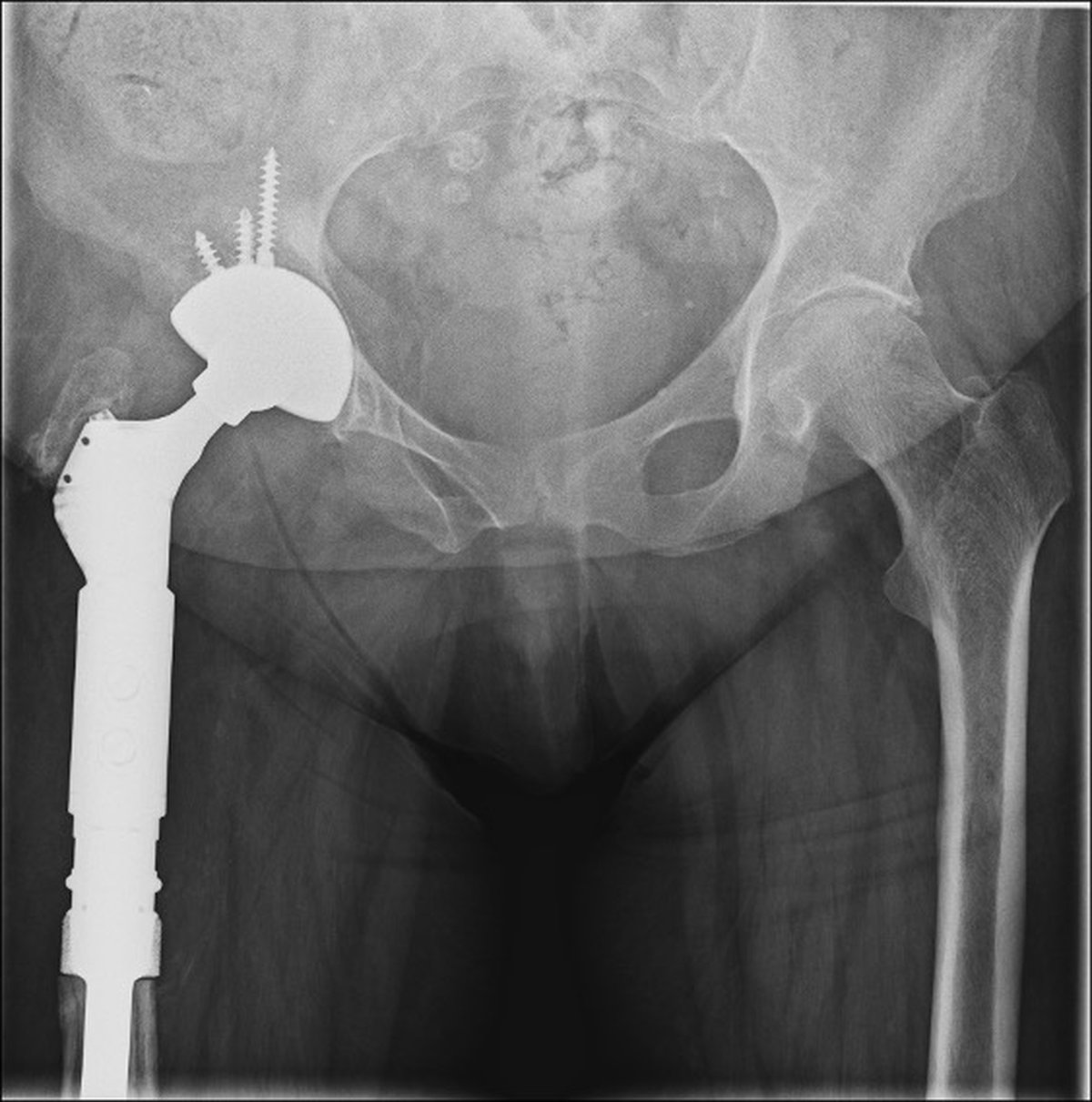 Post-operative pelvic x-ray after staged hip revision to treat chronic infection and reconstruct bone loss