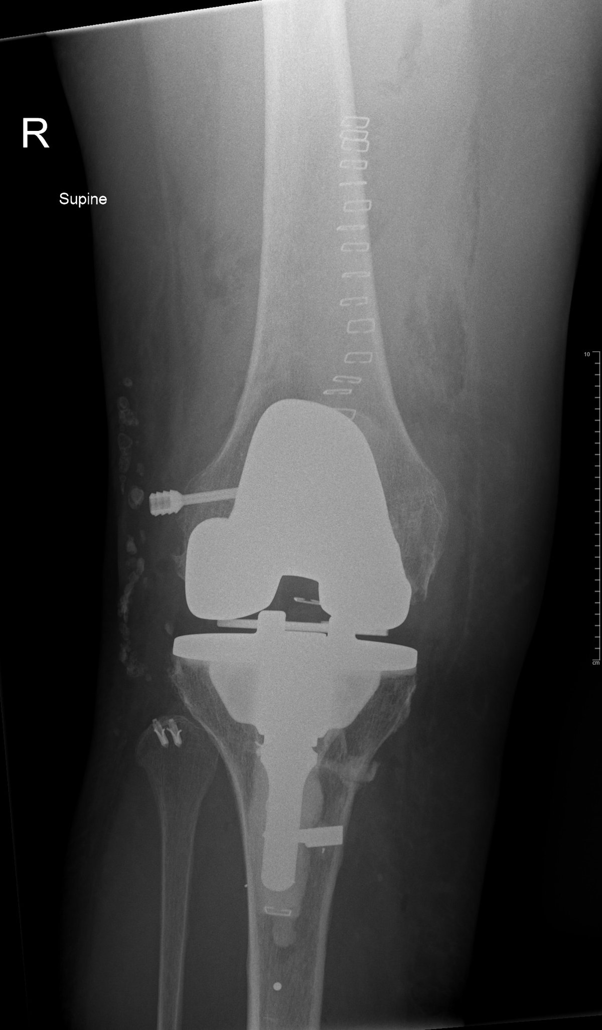Post-operative x-ray after complex knee replacement with a posterior-stabilised implant and stemmed tibial component restoring alignment