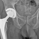X-ray thumbnail of a total hip replacement
