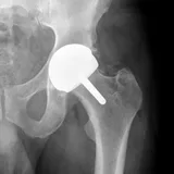 X-ray thumbnail of a hip resurfacing