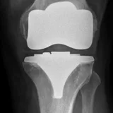 X-ray thumbnail of a total knee replacement