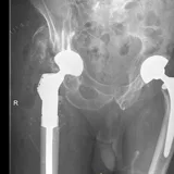 X-ray thumbnail of a revision hip replacement