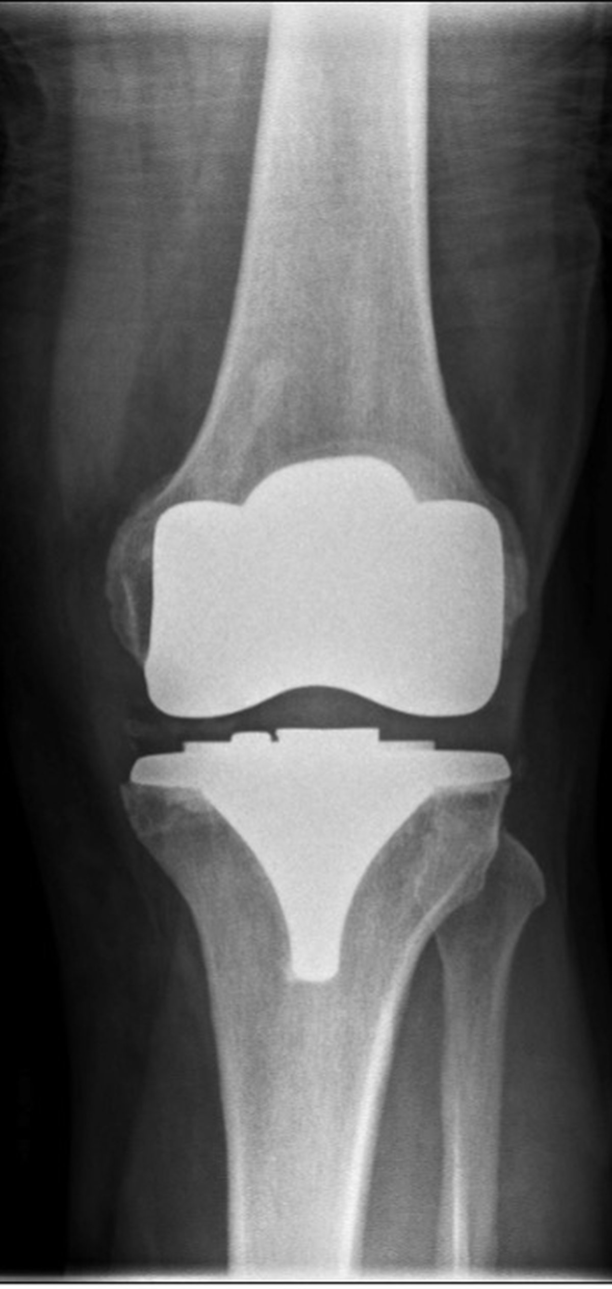 Post-operative knee x-ray after total knee replacement with well-positioned implant and restored joint surfaces