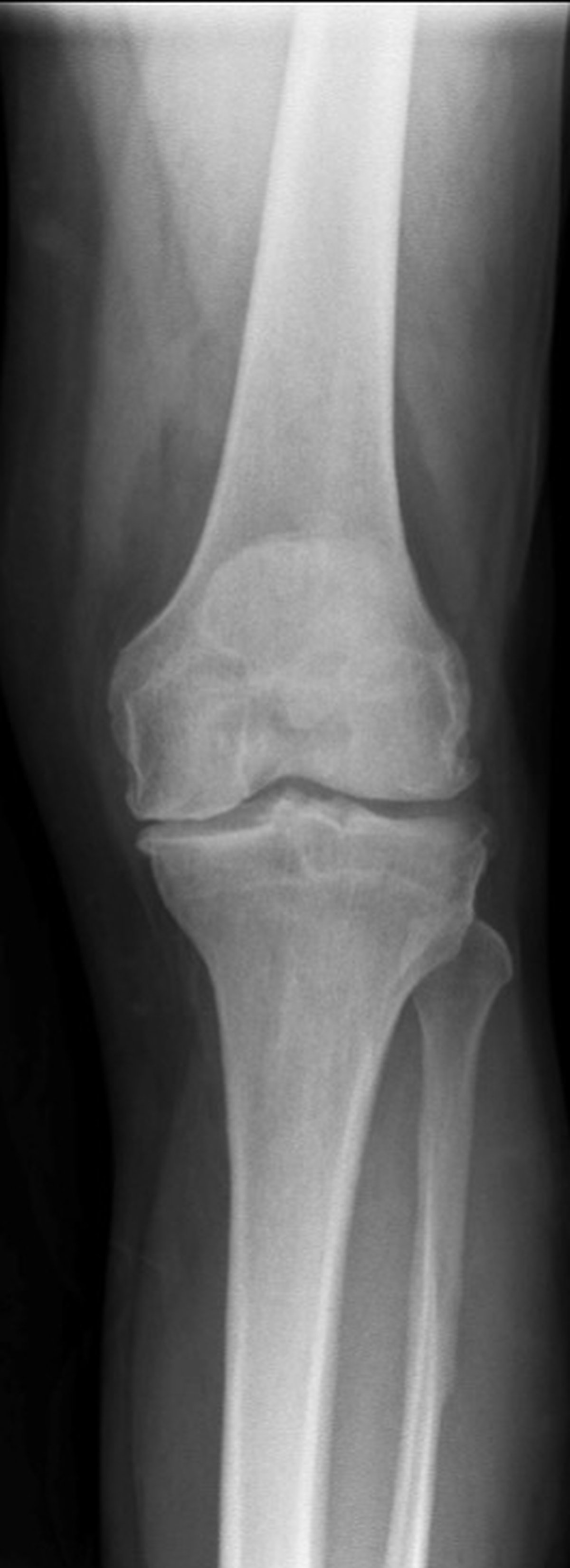 Pre-operative knee x-ray showing tricompartmental osteoarthritis with joint space narrowing across all three compartments